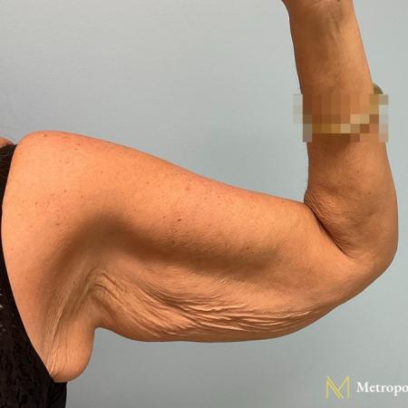 Before image 1 Case #112291 - Brachioplasty