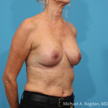 After image 2 Case #114231 - Bilateral Augmentation Mastopexy