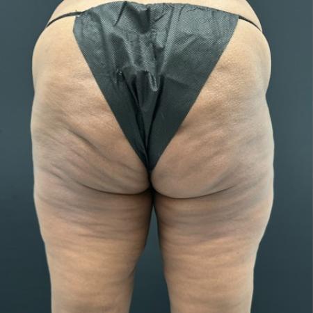 Before image 3 Case #112451 - Hi-Definition Abdominoplasty with Renuvion