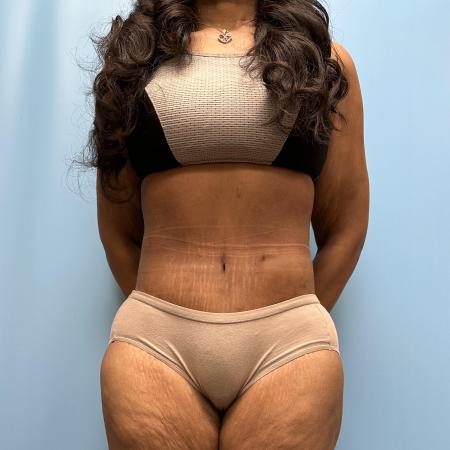 After image 1 Case #112356 - Body Lift/360 Tummy Tuck