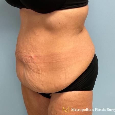 Before image 2 Case #112281 - Abdominoplasty