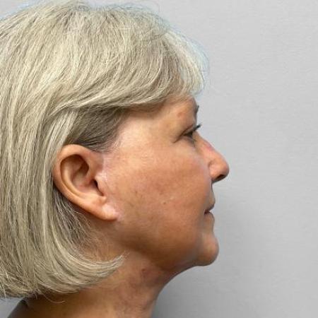 After Case #114711 - Facelift & TFX