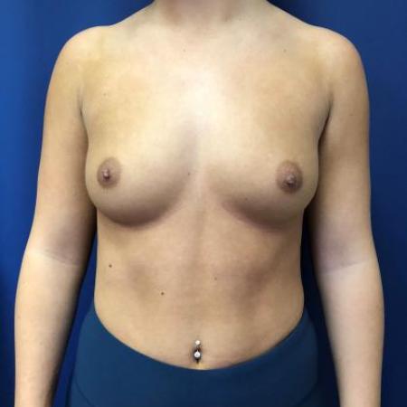 Before image 1 Case #114391 - Happy breasts at 4 years postop!