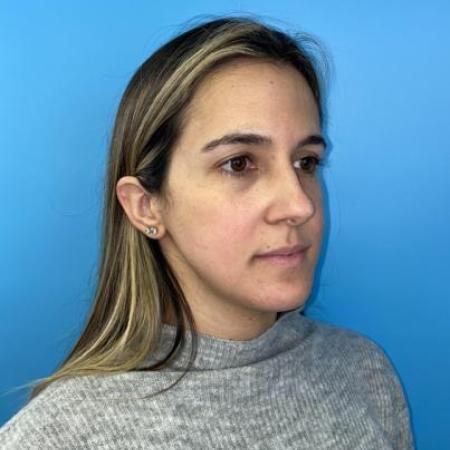 Before image 5 Case #114356 - Smiling 6 months after Rhinoplasty