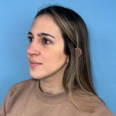 After image 2 Case #114356 - Smiling 6 months after Rhinoplasty