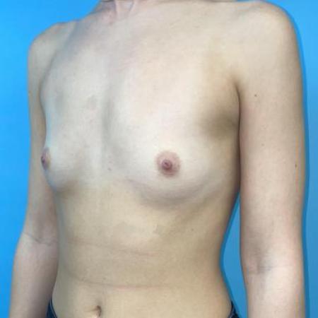 Before image 2 Case #114381 - 25 yr old with "dream boobs"...
