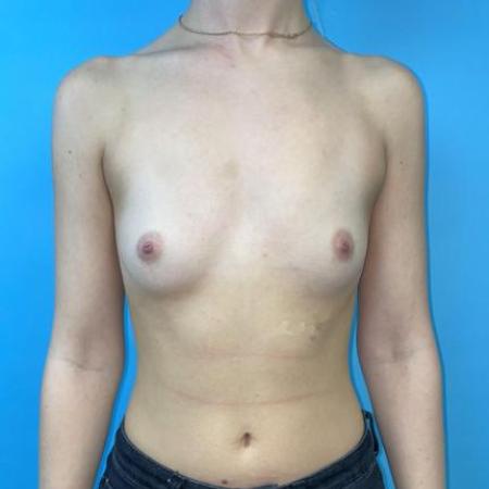 Before image 1 Case #114381 - 25 yr old with "dream boobs"...