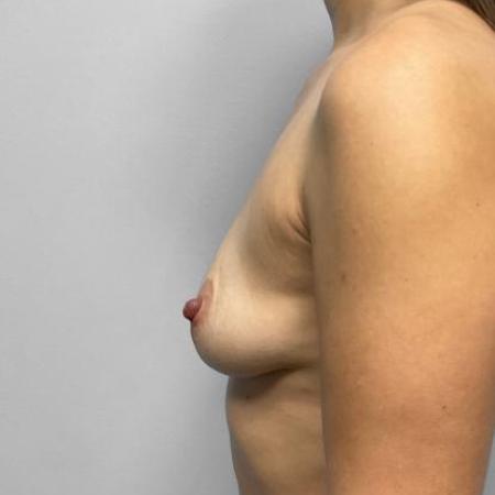 Before Case #114836 - Breast Augmentation