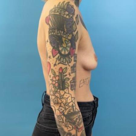 Before image 5 Case #114376 - Implants nice and low at only 6 weeks out...