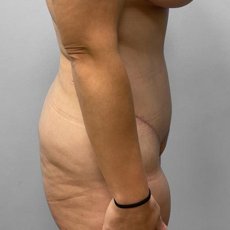 After Case #114826 - Tummy Tuck & Liposuction
