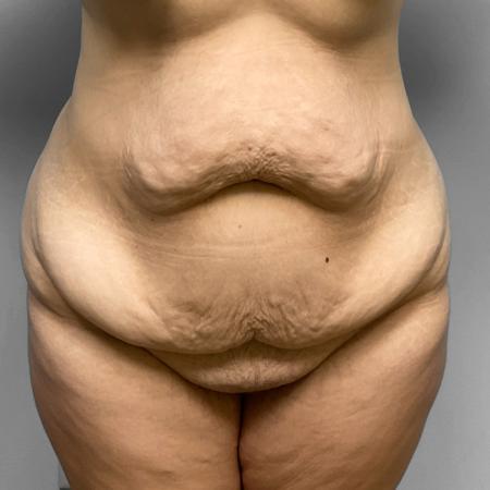 Before Case #114826 - Tummy Tuck & Liposuction