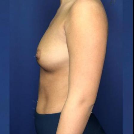 Before image 3 Case #114391 - Happy breasts at 4 years postop!