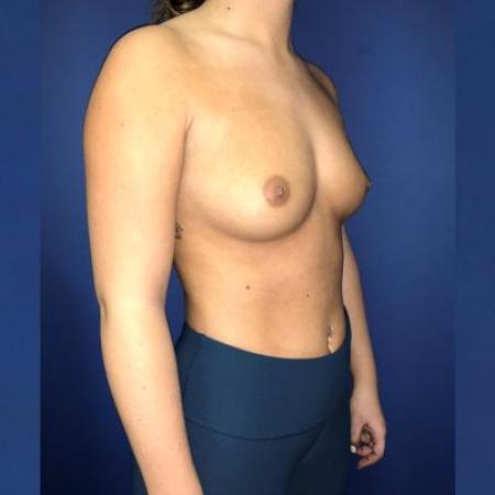 Before image 4 Case #114391 - Happy breasts at 4 years postop!