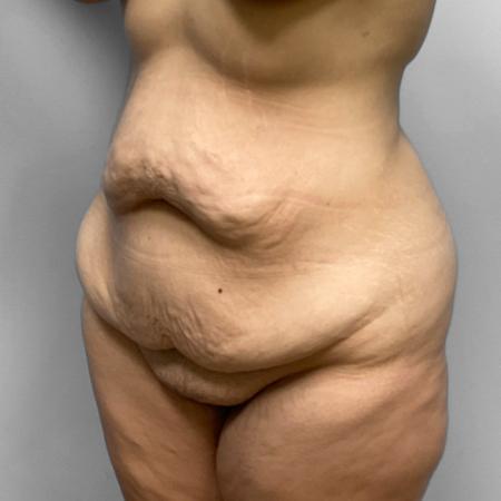 Before Case #114826 - Tummy Tuck & Liposuction