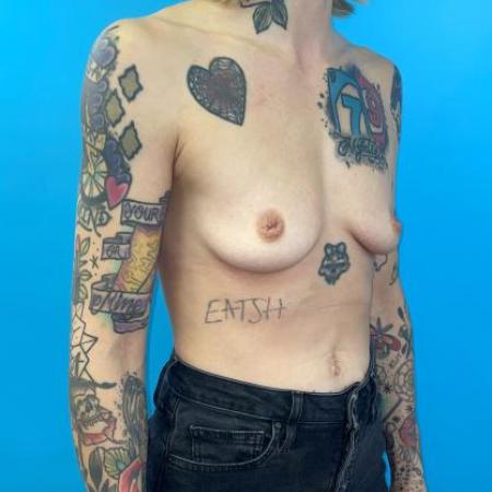 Before image 4 Case #114376 - Implants nice and low at only 6 weeks out...