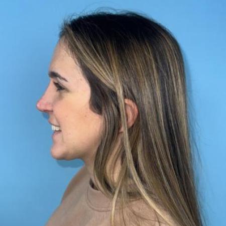 After image 1 Case #114356 - Smiling 6 months after Rhinoplasty