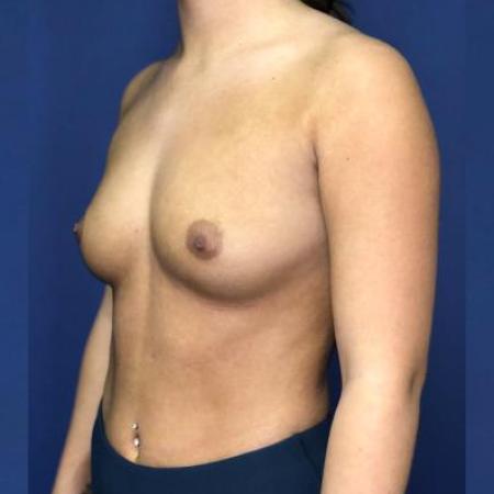 Before image 2 Case #114391 - Happy breasts at 4 years postop!