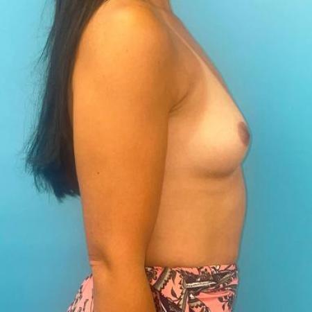 Before image 5 Case #114371 - Breast Augmentation 10 weeks postop