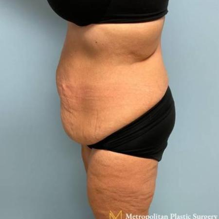 Before image 3 Case #112281 - Abdominoplasty