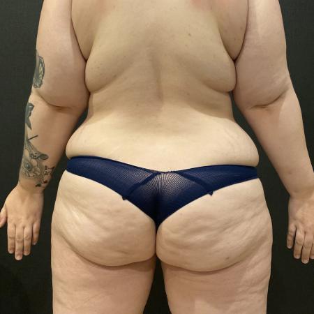 Before image 3 Case #114191 - Abdominoplasty with Liposuction of Chest & Flanks