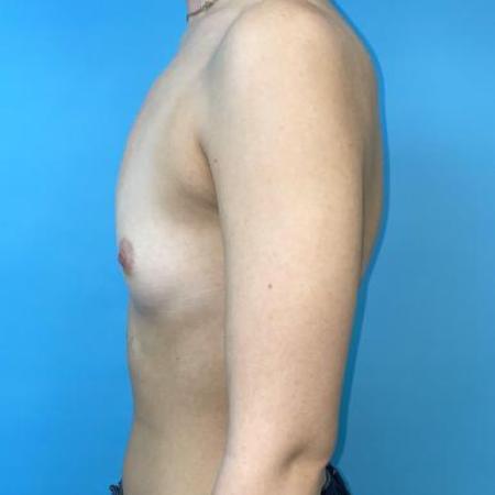 Before image 3 Case #114381 - 25 yr old with "dream boobs"...