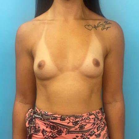 Before image 1 Case #114371 - Breast Augmentation 10 weeks postop