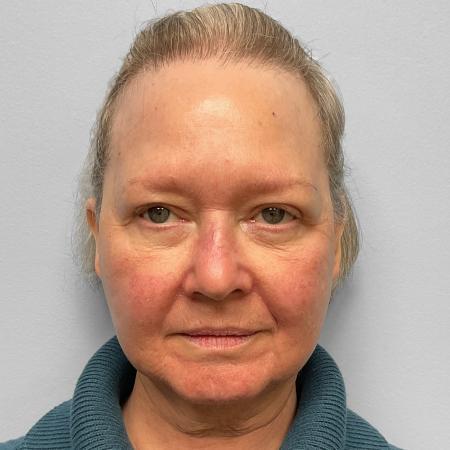 Before Case #114711 - Facelift & TFX