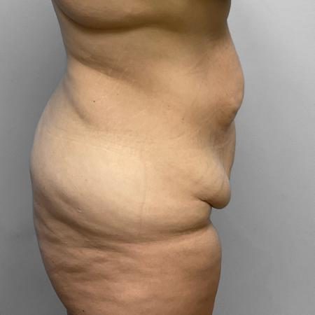 Before Case #114826 - Tummy Tuck & Liposuction