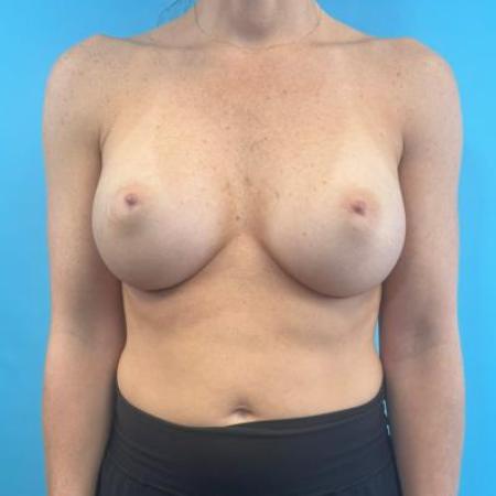 After image 1 Case #114681 - Breast Implants plus a little extra...