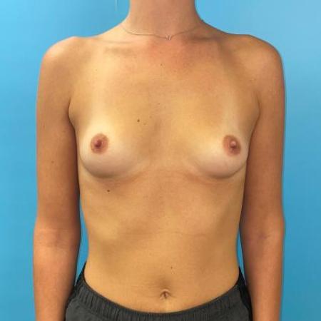 Before image 1 Case #114386 - Natural breast implants at 6 weeks and 7 months.