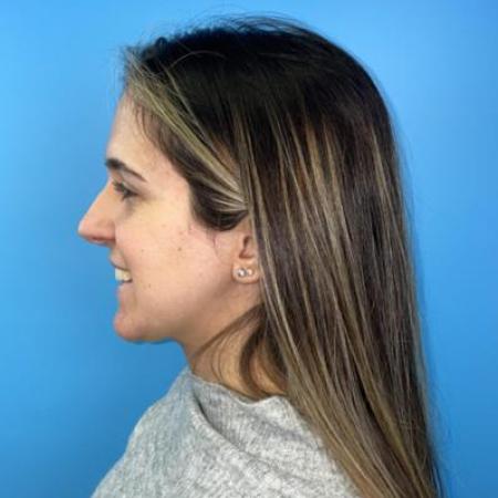 Before image 1 Case #114356 - Smiling 6 months after Rhinoplasty