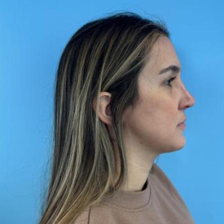 After image 6 Case #114356 - Smiling 6 months after Rhinoplasty