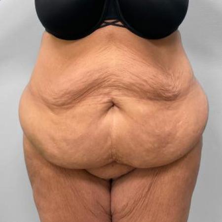 Before Case #115186 - Tummy Tuck and Lipo