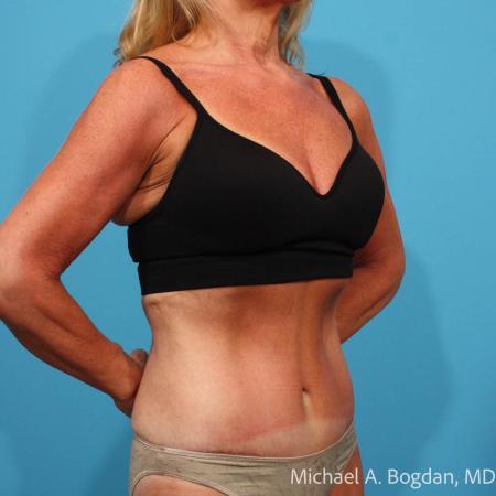 After image 2 Case #115361 - Tummy Tuck