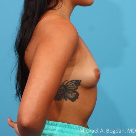 Before image 3 Case #115341 - Breast Augmentation