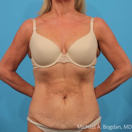 Before image 1 Case #115361 - Tummy Tuck