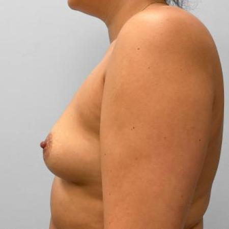 Before image 3 Case #115231 - Breast Augmentation