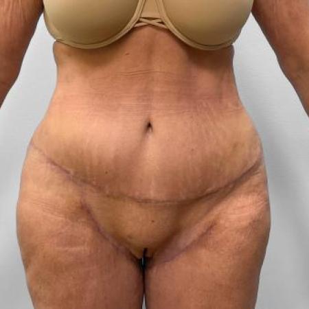 After Case #115186 - Tummy Tuck and Lipo