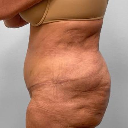 After Case #115186 - Tummy Tuck and Lipo