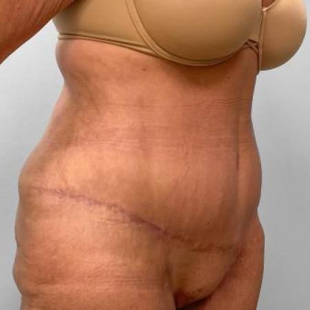 After Case #115186 - Tummy Tuck and Lipo