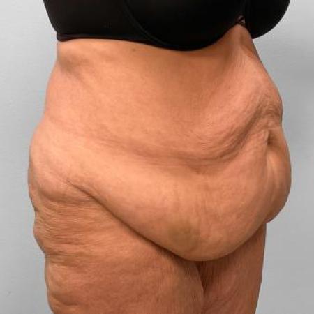 Before Case #115186 - Tummy Tuck and Lipo