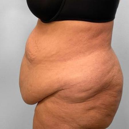 Before Case #115186 - Tummy Tuck and Lipo
