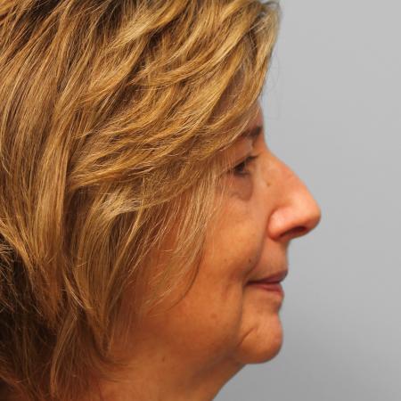 Before image 3 Case #115706 - Upper & Lower Blepharoplasty