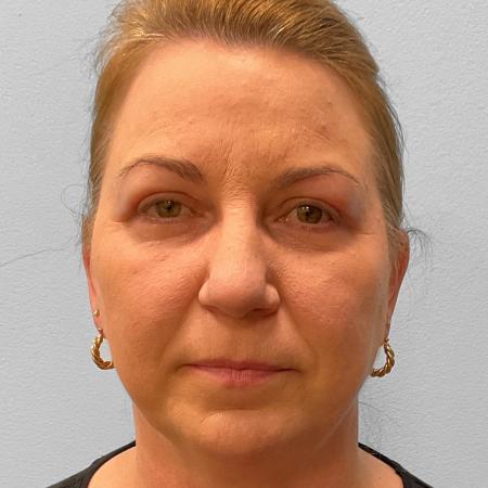 After image 1 Case #115721 - Upper & Lower Blepharoplasty