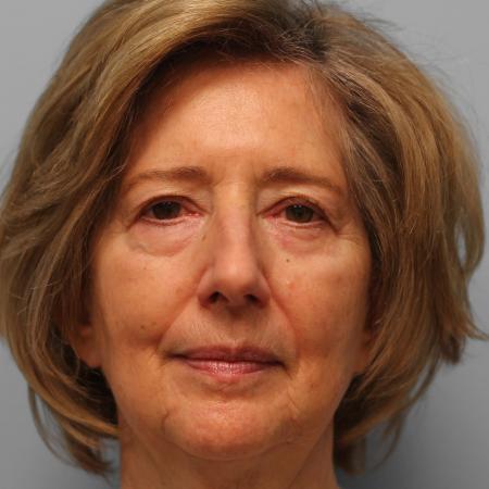 Before image 1 Case #115706 - Upper & Lower Blepharoplasty