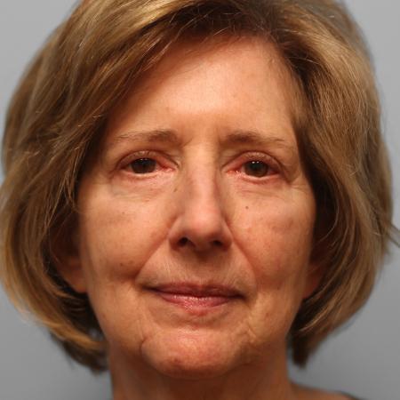 After image 1 Case #115706 - Upper & Lower Blepharoplasty