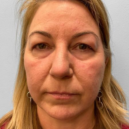 Before image 1 Case #115721 - Upper & Lower Blepharoplasty