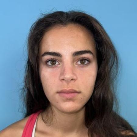 After image 1 Case #115801 - A new nose before starting college...