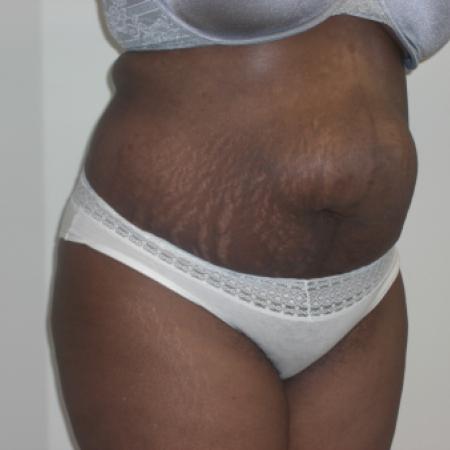 Before image 2 Case #116416 - Abdominoplasty and Hernia Repair