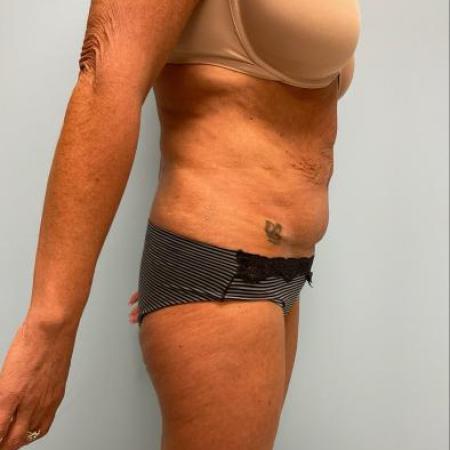 Before image 2 Case #112261 - Tummy tuck